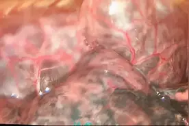 真实案例！内镜下，吸烟40年的肺长这样？看完不敢抽了图片