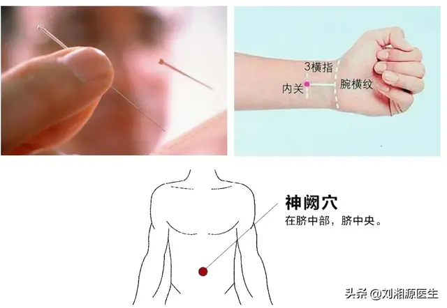 【免疫相关不良妊娠答疑解惑33】——孕期呕吐