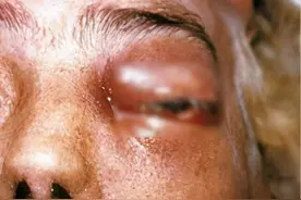 印度出现的黑真菌病到底是何来头？会相互传染？我们又该如何防范图片