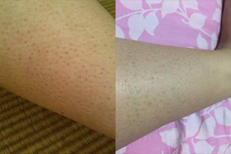 重症毛囊角化病