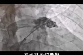 视频带你了解左心耳封堵术图片