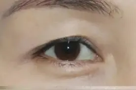 做提眉手术会后悔？医生分享几个提眉手术的真相图片