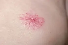 身上长出了红色“蜘蛛”，我还有救吗？图片