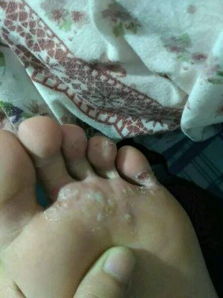 痒痒痒，常见的7种皮肤病用药大全！