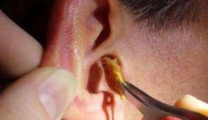 宝宝腿上长的像鸡皮疙瘩一样的东西