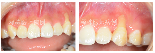 牙龈"萎缩"可以手术治疗