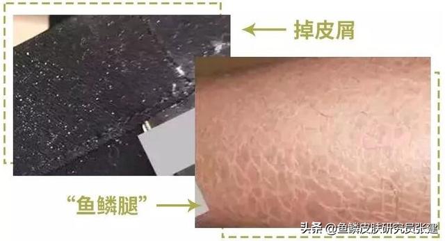 皮肤干燥鱼鳞状小疙瘩