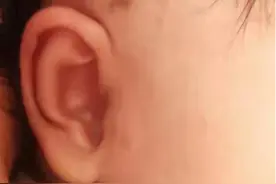 耳朵卷曲，原来她叫“杯状耳”图片