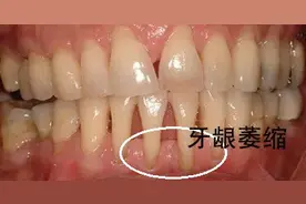 全中国有一半的人都会牙龈萎缩，有这几种症状的要注意了图片