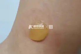 女子睡梦中脚被火烤，醒来看见一水泡，近两天低温烫伤的人不少图片