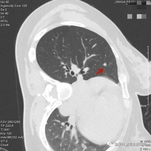 叶建明谈结节：检查发现肺实性结节怎么办？个人版实用指南