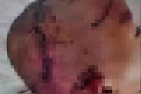 愤怒！山东2条恶犬先后咬伤两幼童，浑身是血紧急手术，狗主来医院20分钟走了图片
