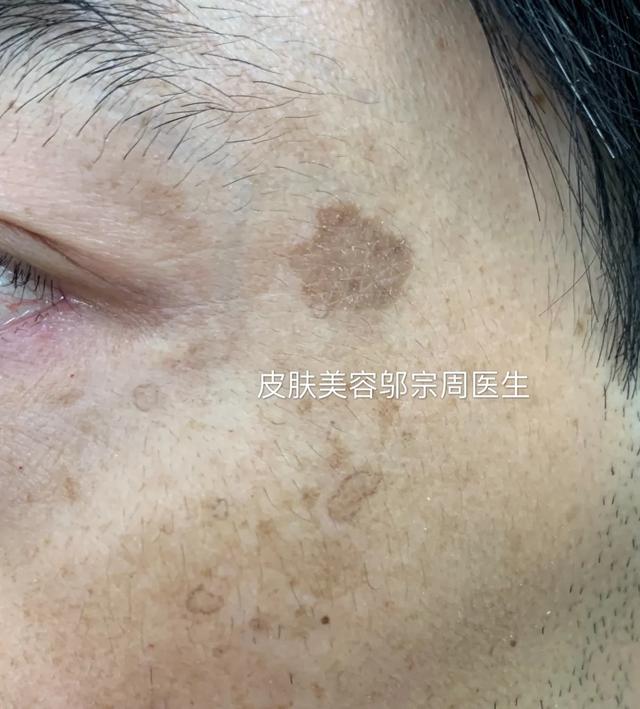 黄褐斑和汗孔角化症