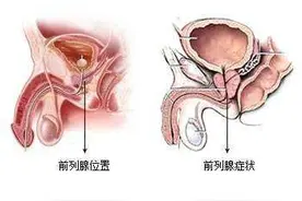 男性前列腺大科普，你真的了解前列腺吗？图片