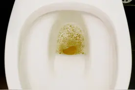 泡沫尿，就是蛋白尿，就是肾功不全吗？医生辟谣，讲清楚诸多因素图片