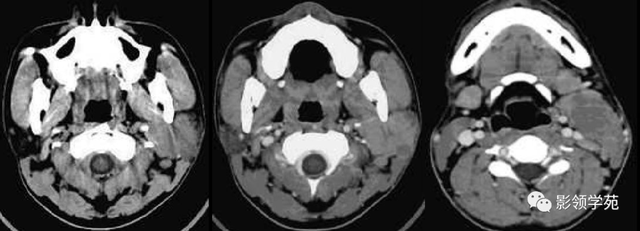 腮腺角化型鳞癌