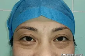 做完外切祛眼袋手术，我后悔了：后悔没早做图片