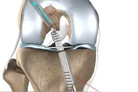 前叉重建术后多久可以脱拐呢？图片