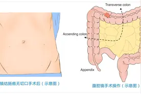 无切口+保功能！宜宾市二医院胃肠外科开展四川省第一例功能性横结肠癌NOSES手术！图片