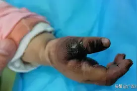 可怕！一个动作，小孩手被烧黑，严重可致命！广西基本上每家每户都有……图片