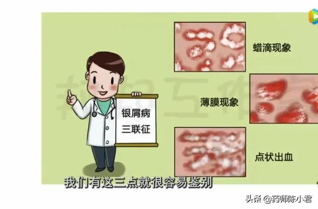 薄膜现象是角化不全