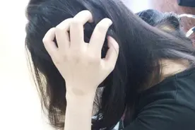 头皮痒，从头上抓出“白泥”，是怎么回事？图片