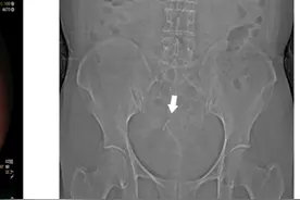 放了28年的“T型”节育环，竟从子宫“飞”到了肠子上图片