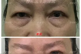 55岁的阿姨眼袋太严重了！做完这个治疗后，年轻了不止10岁图片