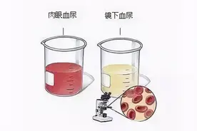 警惕！出现无痛血尿可能是得了这种癌图片