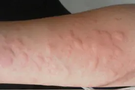 慢性荨麻疹患者的饮食应该如何注意？图片