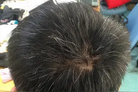 白头发增多，不要以为是衰老了，也许是体内2种维生素“见底了”图片