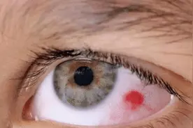 人的眼球很脆弱 如果眼球受伤充血了怎么办图片