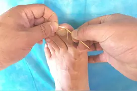 塞点棉花也能治甲沟炎？手足外科医生手把手教你图片