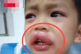 4岁男童“嘟嘟嘴”，亲爸心疼又好笑，孩子食物过敏不容忽视图片