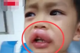 4岁男童“嘟嘟嘴”，亲爸心疼又好笑，孩子食物过敏不容忽视图片