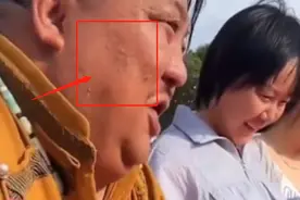 一顿一只羊！近400斤的胖网红脸现脂肪斑，网友担心成下个泡泡龙图片