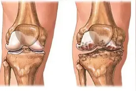 膝关节软骨损伤的十种原因，个个都可引发骨关节炎，你中了几个？图片