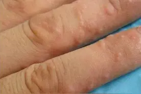 手上长小泡，反复发作老不好？医生：想快速摆脱它，4件事得少做图片