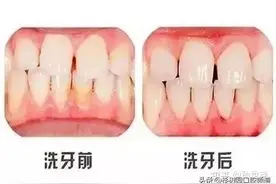 关于洗牙，常被问到的10个问题图片
