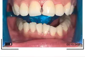 左上2全瓷冠加前门牙修复图片