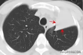 【医者解读】成人肺不张的发生与治疗图片