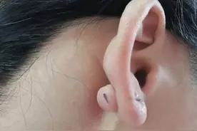 打耳洞后长的瘢痕疙瘩怎么治疗图片