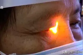 眼睛看不清还老有东西遮挡，以为是白内障，其实患上“眼癌之王”图片