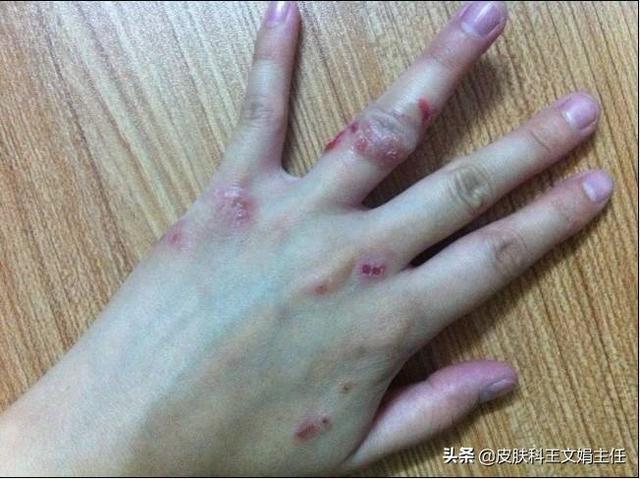 神经性皮炎皮肤异常角化
