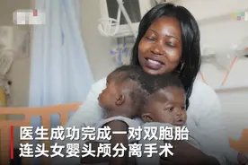 2岁连体双胞胎姐妹，近2年的手术规划3次手术成功在意大利分离图片