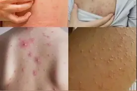 你脸上有这四种现象，说明你有螨了图片