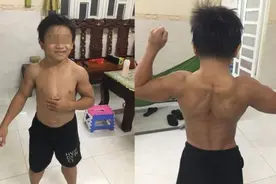 越南10岁男孩天生肌肉发达，被医生诊断为“超人综合征”图片
