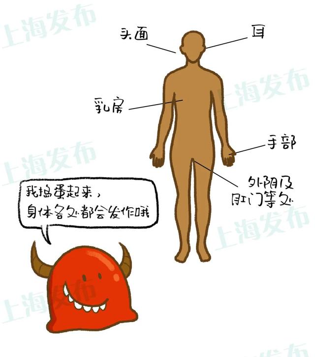 角化性湿疹传染么