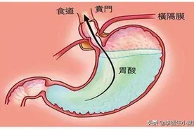 烧心反酸，反流性食管炎该怎么办？医生：这三类药物，效果极佳图片
