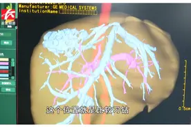 12岁男童腹痛一查医生都吓坏了！肝脏竟长了一个800多克“大包”视频封面
